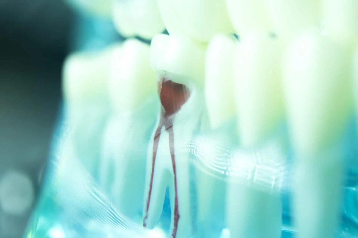 single sitting rct treatment near me