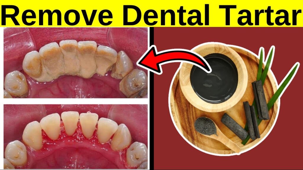 How To Remove Tartar From Teeth Without Dentist