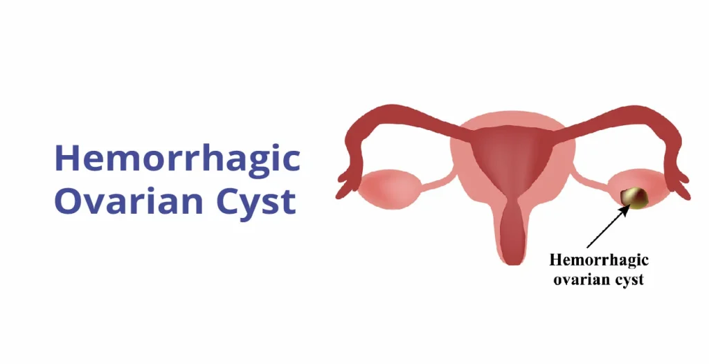 Ovarian Cysts; Symptoms, Diagnosis, and Treatment