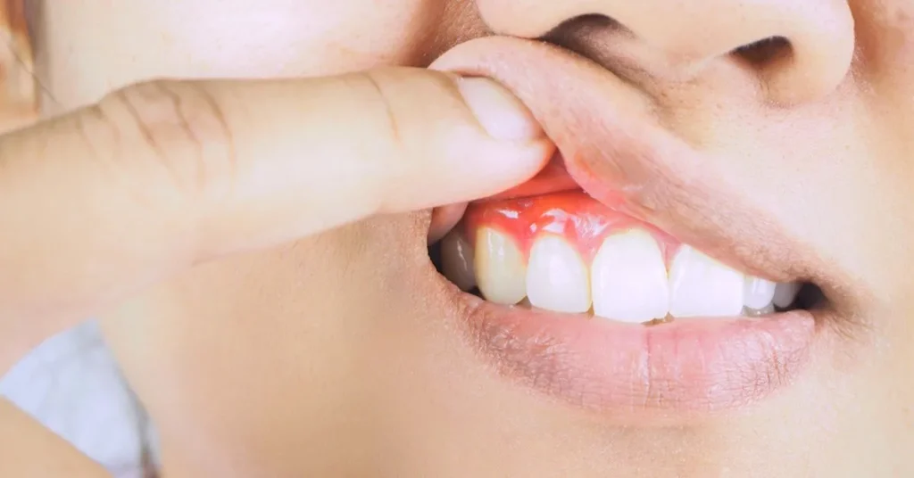 How Healthy Habits Can Stop Gum Disease Before It Starts